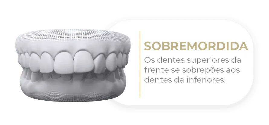 Caso tratável com Invisalign
