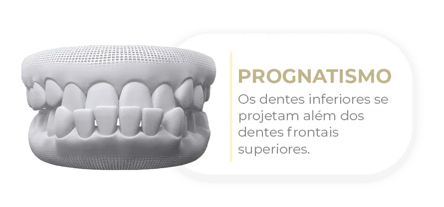 Caso tratável com Invisalign