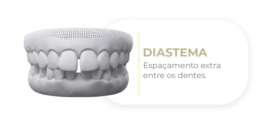 Caso tratável com Invisalign