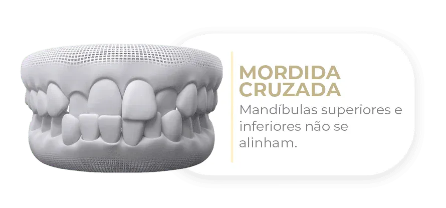 Caso tratável com Invisalign
