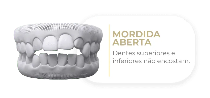 Caso tratável com Invisalign