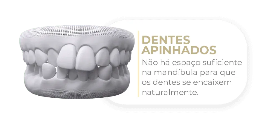 Dentes apinhados