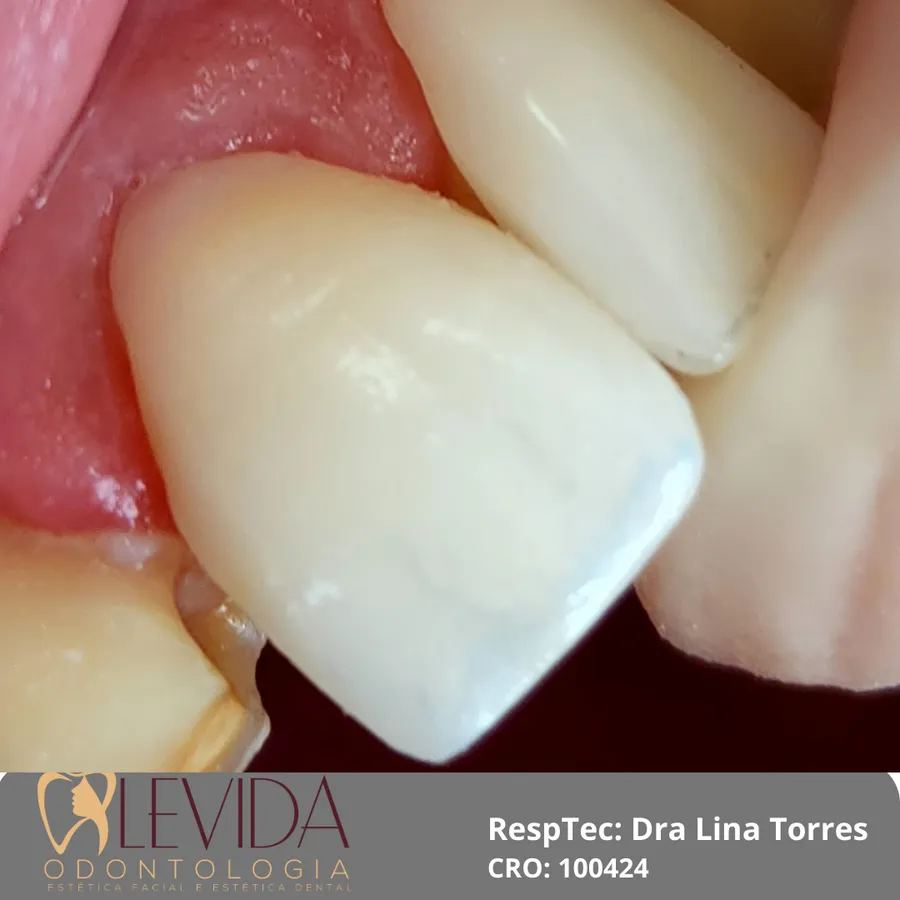 Resultado de lentes de contato dental 2