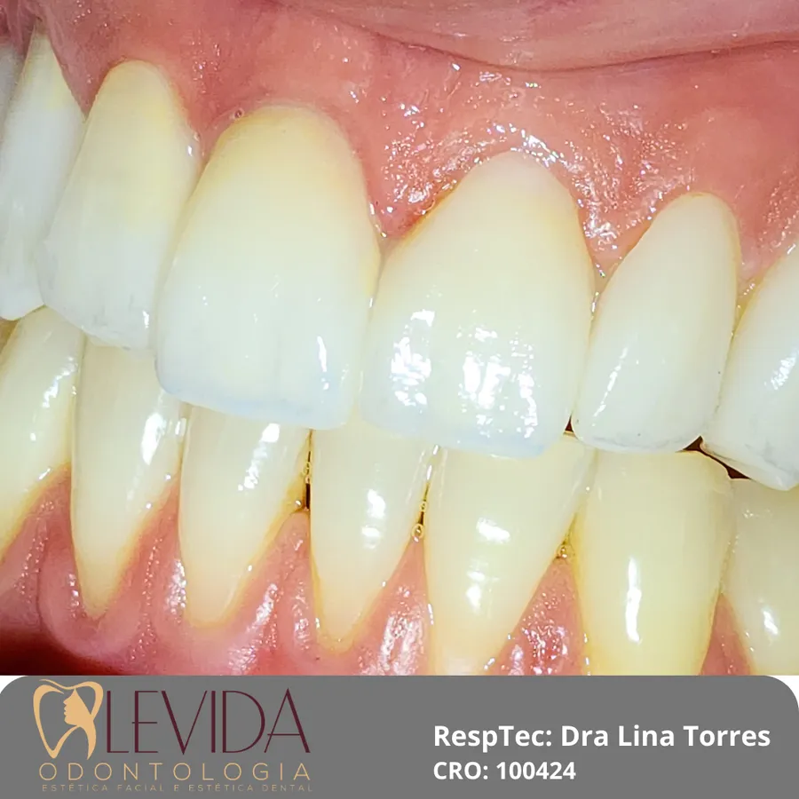 Resultado de lentes de contato dental 3