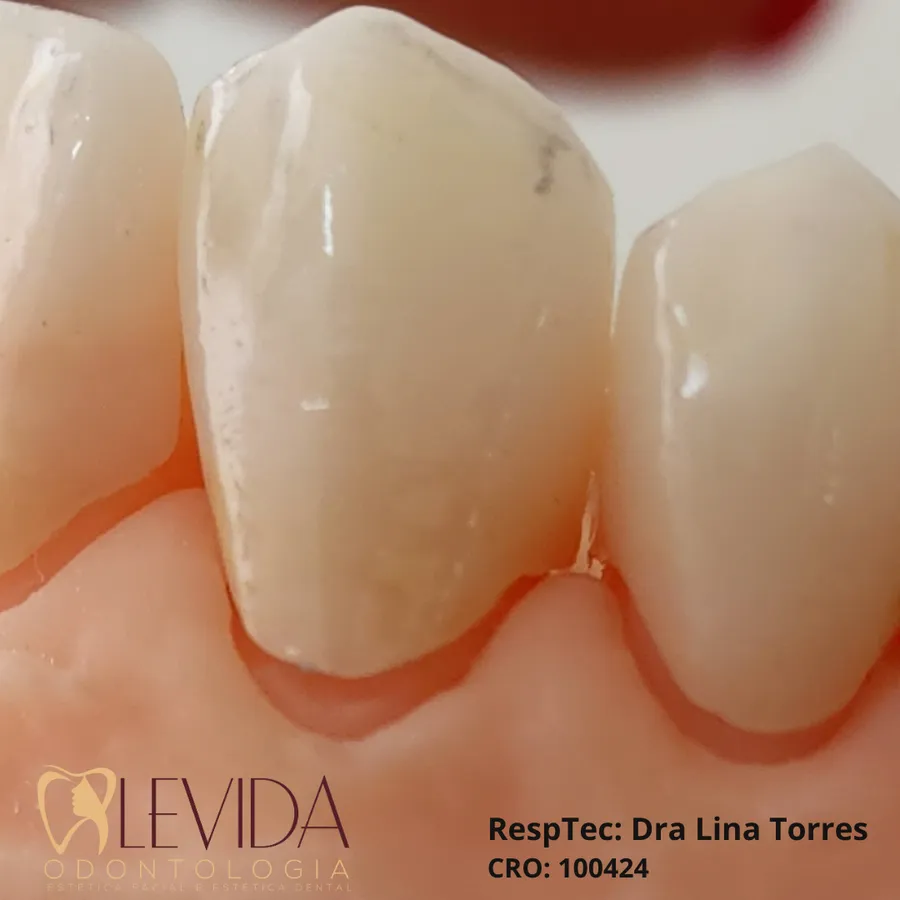 Resultado de lentes de contato dental 4