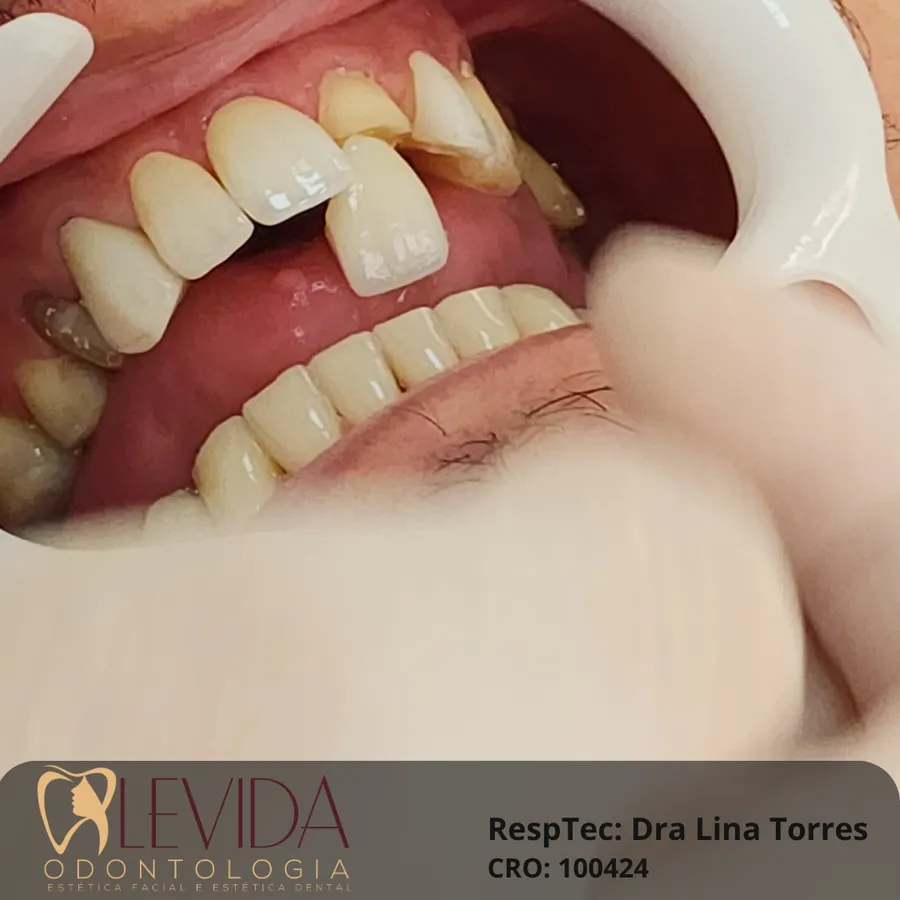 Resultado de lentes de contato dental 5