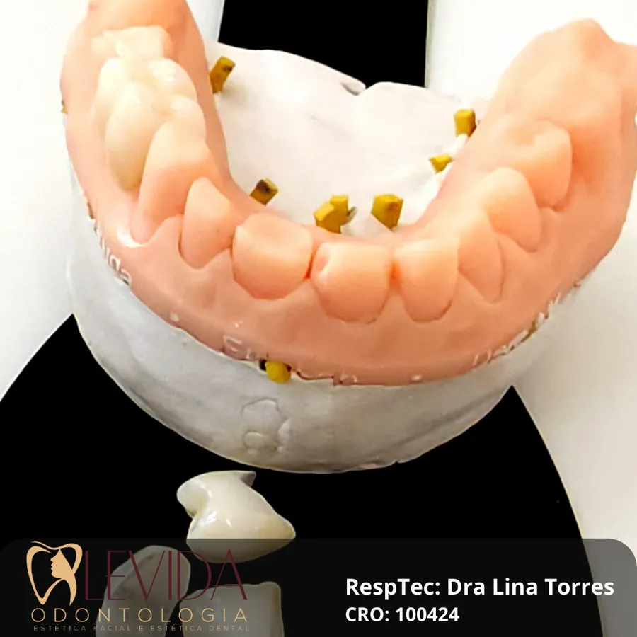 Resultado de lentes de contato dental 6