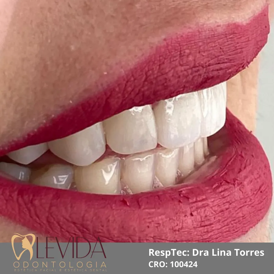 Resultado de lentes de contato dental 1