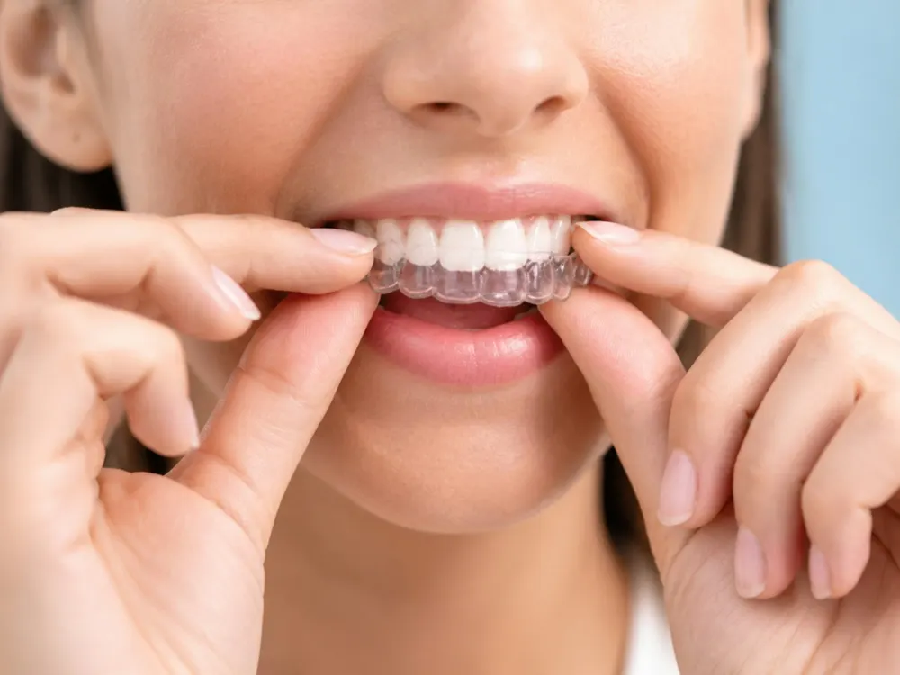 Alinhador transparente Invisalign