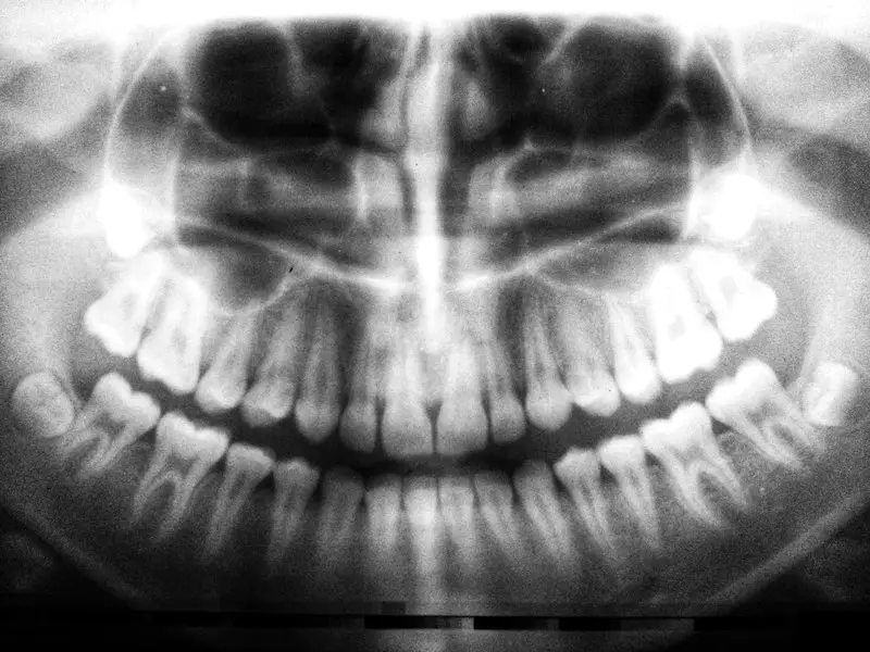 Radiografia panorâmica mostrando os dentes do siso